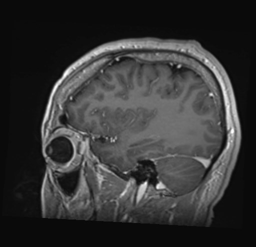 Cochlear incomplete partition type III associated with hypothalamic hamartoma (Radiopaedia 88756-105498 Sagittal T1 C+ 40).jpg