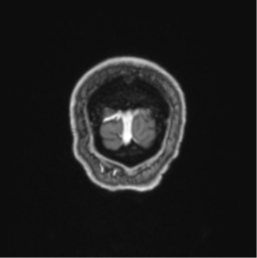 File:Colloid cyst of the third ventricle (Radiopaedia 86571-102662 Coronal T1 C+ 6).png