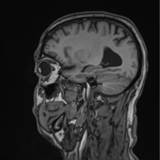 File:Colloid cyst of the third ventricle (Radiopaedia 86571-102662 Sagittal T1 24).png