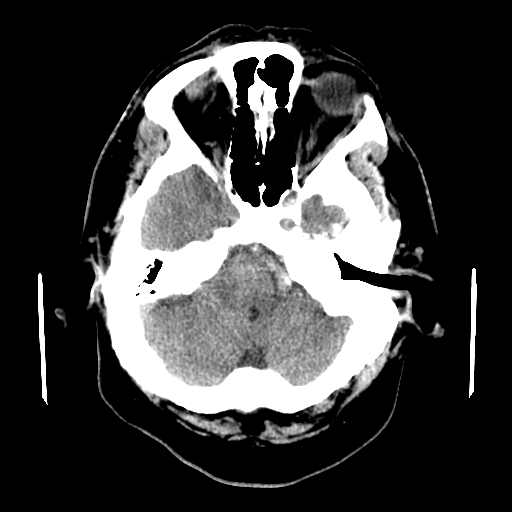 File:Colloid cyst with anterior communicating artery aneurysm (Radiopaedia 33901-35090 Axial non-contrast 4).jpg