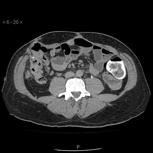 File:Colo-cutaneous fistula (Radiopaedia 40531-43129 A 8).jpg