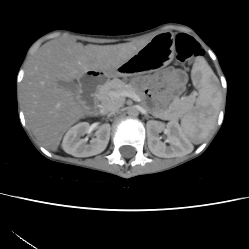 File:Colocolic fistula - Crohn disease (Radiopaedia 57063-63955 A 21).jpg
