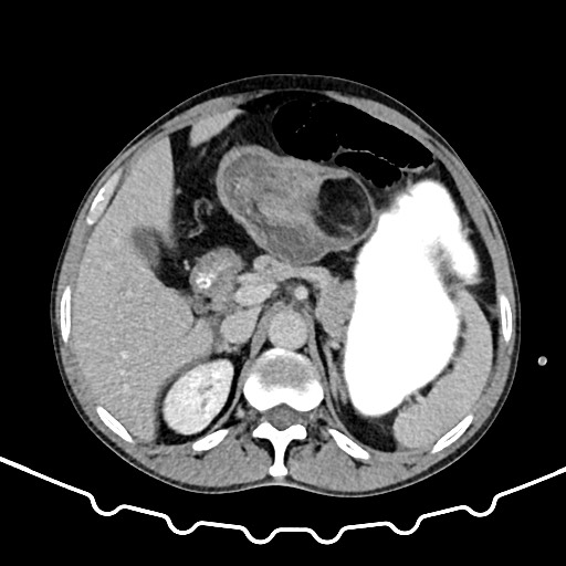 File:Colocolic intussusception due to large lipoma (Radiopaedia 68773-78482 A 46).jpg
