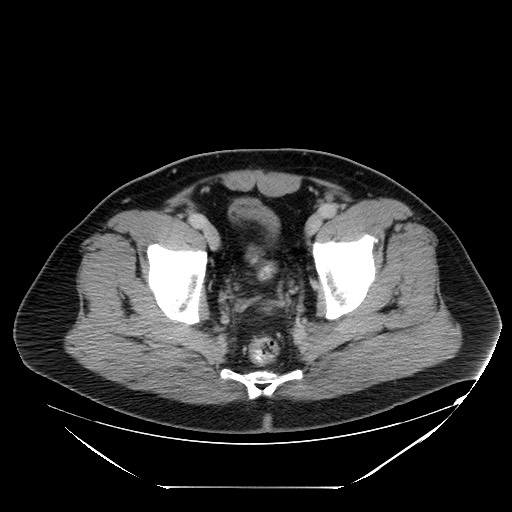 Colocolic intussusception due to lipoma (Radiopaedia 73712-84508 A 105).jpg
