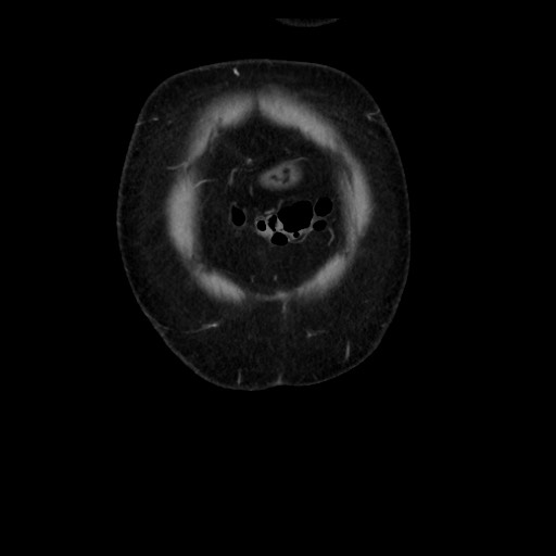 Colocolic intussusception due to tubular adenoma (Radiopaedia 73744-84551 B 17).jpg