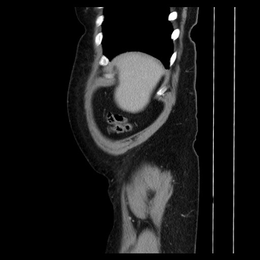 Colocolic intussusception due to tubular adenoma (Radiopaedia 73744-84551 C 31).jpg