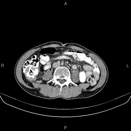 File:Colon adenocarcinoma - hepatic flexure (Radiopaedia 85635-101395 Axial C+ delayed 52).jpg