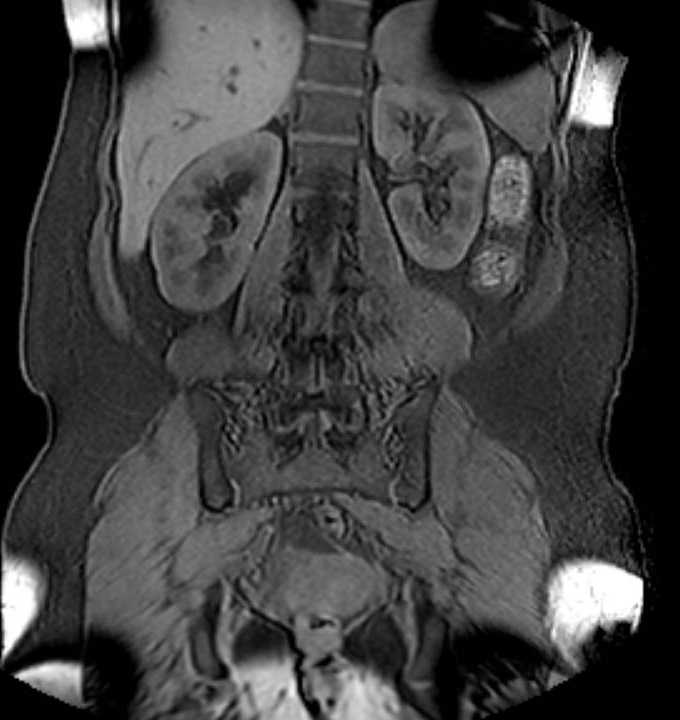 Colon adenocarcinoma with Krukenberg tumors, advanced pregnancy (Radiopaedia 67279-76645 E 69).jpg