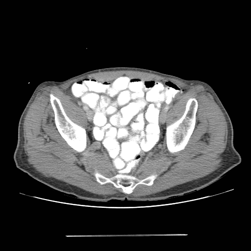 File:Colon cancer with calcified liver metastasis (Radiopaedia 74423-85307 A 65).jpg