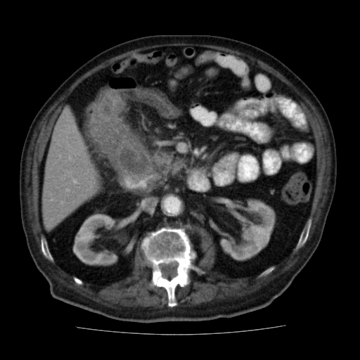 File:Colon cancer with duodenal invasion (Radiopaedia 16278-15958 A 25).jpg