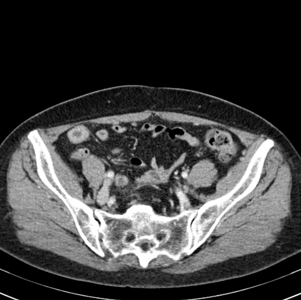 Colon carcinoma with hepatic metastases (Radiopaedia 29477-29961 A 89).jpg