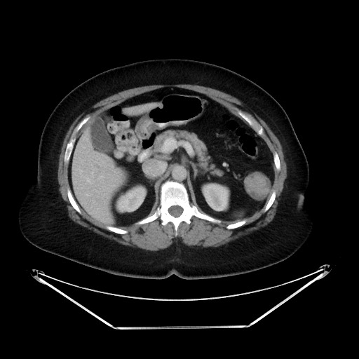 File:Colonic intussusception due to adenocarcinoma (Radiopaedia 86828-102987 A 50).jpg