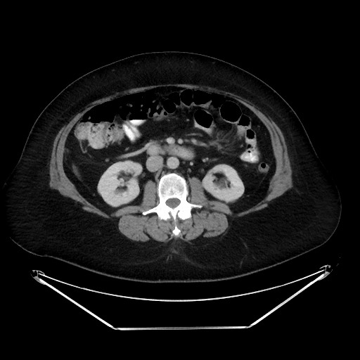 File:Colonic intussusception due to adenocarcinoma (Radiopaedia 86828-102987 A 70).jpg