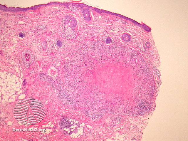 File:Figure 1 (DermNet NZ pathology-e-lmdf-figure-1).jpg