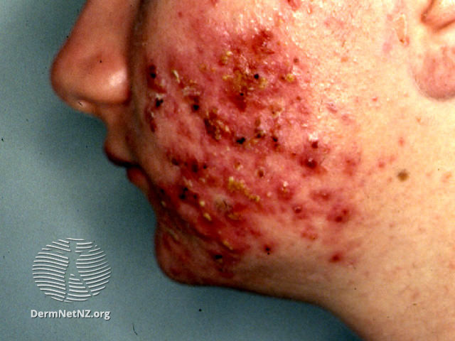 File:Gram negative folliculitis (DermNet NZ acne-gramneg).jpg