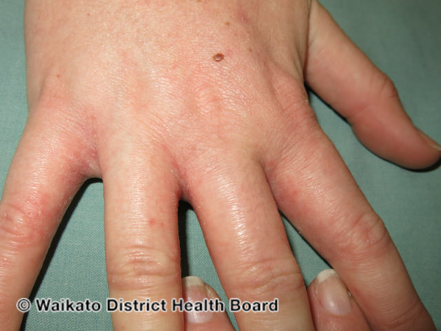 File:Hand dermatitis (DermNet NZ contact-dermatitis-isocyanate-03).jpg