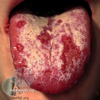 File:Herpes simplex (DermNet NZ 2862).jpg