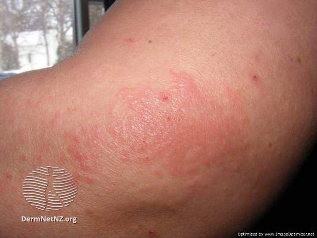 File:Image provided by Sharon Morton (DermNet NZ reactions-progesterone-dermatitis).jpg