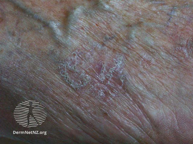 Intraepidermal carcinoma (DermNet NZ lesions-scc-in-situ-2949).jpg