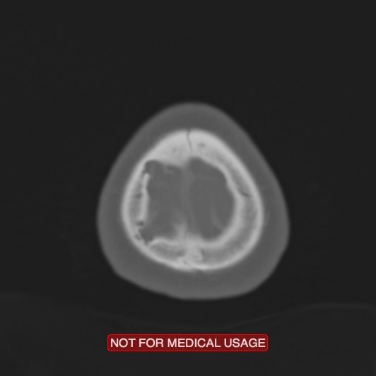 File:Nasopharyngeal carcinoma recurrence - skull base destruction (Radiopaedia 29107-29490 Axial bone window 8).jpg