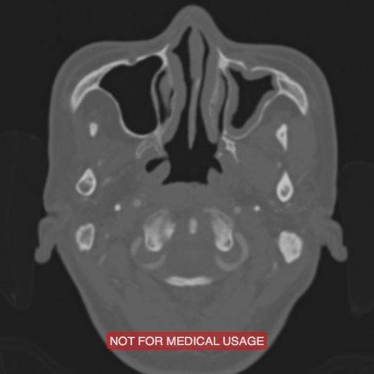 Nasopharyngeal carcinoma recurrence - skull base destruction (Radiopaedia 29107-29490 Axial bone window 99).jpg