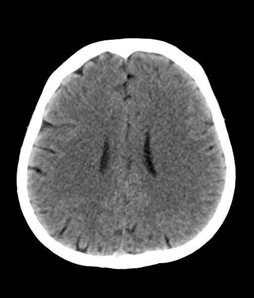 File:Nasopharyngeal carcinoma with cerebral abscess (Radiopaedia 43018-46275 Axial non-contrast 35).png