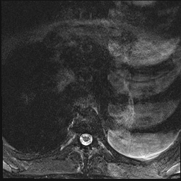 File:Nasopharyngeal carcinoma with skull base invasion (Radiopaedia 59258-66600 Axial T2 fat sat 36).jpg