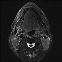 File:Nasopharyngeal carcinoma with skull base invasion (Radiopaedia 59258-66600 D 36).jpg