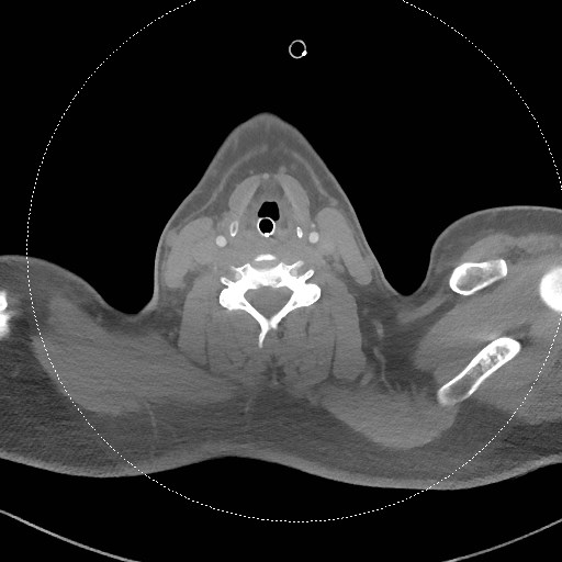 Neck CT angiogram (intraosseous vascular access) (Radiopaedia 55481-61945 B 164).jpg