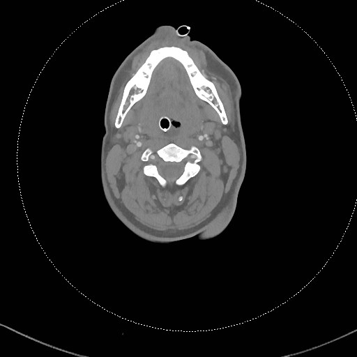 Neck CT angiogram (intraosseous vascular access) (Radiopaedia 55481-61945 B 207).jpg
