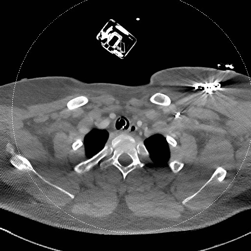 Neck CT angiogram (intraosseous vascular access) (Radiopaedia 55481-61945 B 97).jpg