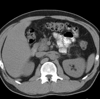 File:Necrotizing pancreatitis with acute necrotic collection (Radiopaedia 14470-14417 Axial non-contrast 14).jpg