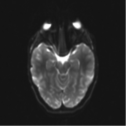 Neurenteric cyst (Radiopaedia 58641-65837 Axial DWI 15).png
