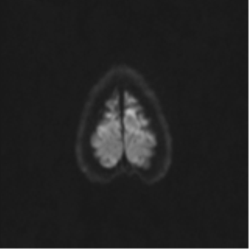 Neurenteric cyst (Radiopaedia 58641-65837 Axial DWI 67).png
