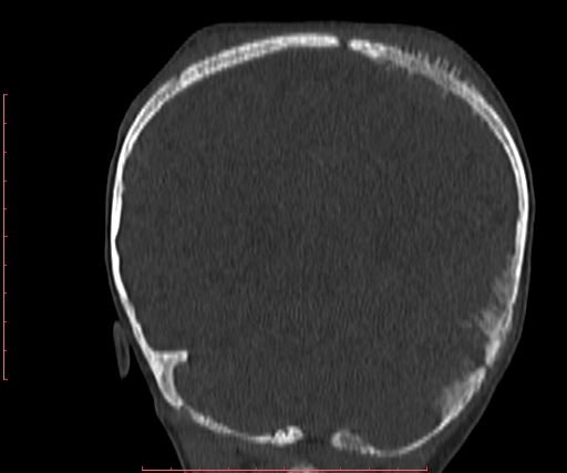 File:Neuroblastoma skull metastasis (Radiopaedia 56053-62683 Coronal bone window 30).jpg