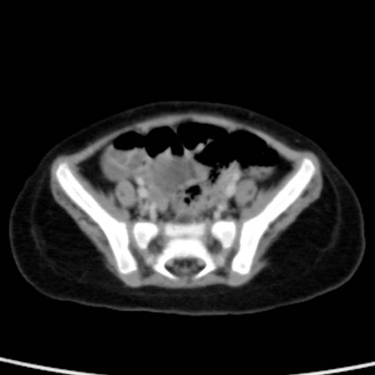 Neuroblastoma with skull metastases (Radiopaedia 30326-30960 C 48).jpg