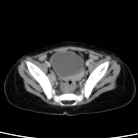 Neuroblastoma with skull metastases (Radiopaedia 30326-30960 C 52).jpg