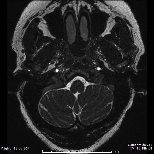 Neurocysticercosis (Radiopaedia 58636-65832 I 31).jpg