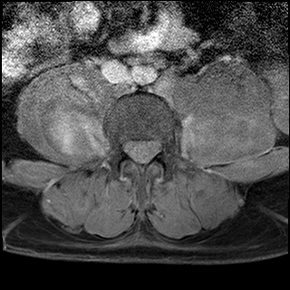 File:Neurofibromatosis type 1- extensive spinal involvement and Christmas tree sign (Radiopaedia 60610-68332 Axial T1 C+ fat sat 52).jpg
