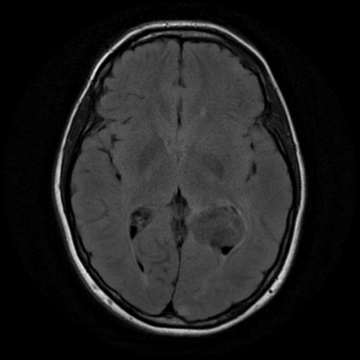 File:Neurofibromatosis type 2 (Radiopaedia 45229-49244 Axial FLAIR 10).png