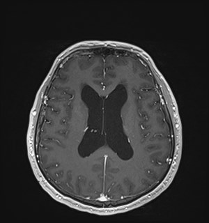 Neurofibromatosis type 2 (Radiopaedia 79097-92049 Axial T1 C+ 120).jpg