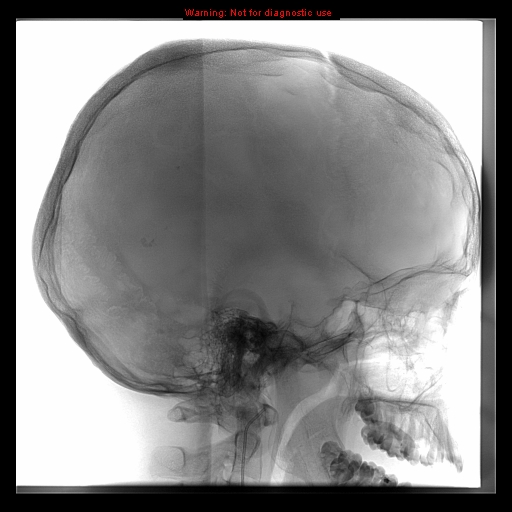 File:Neurofibromatosis type 2 (Radiopaedia 8953-9733 C 1).jpg