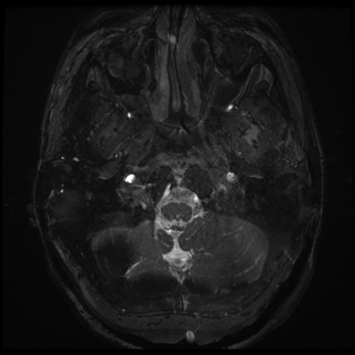 Neurofibromatosis type 2 - bilateral acoustic neuromata (Radiopaedia 40060-42566 Axial FIESTA 1).png
