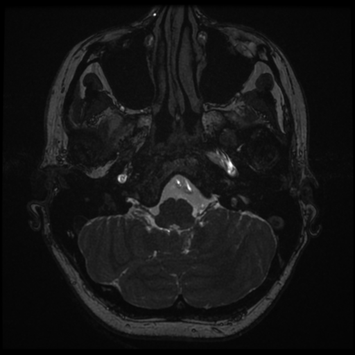 Neurofibromatosis type 2 - bilateral acoustic neuromata (Radiopaedia 40060-42566 Axial FIESTA 17).png