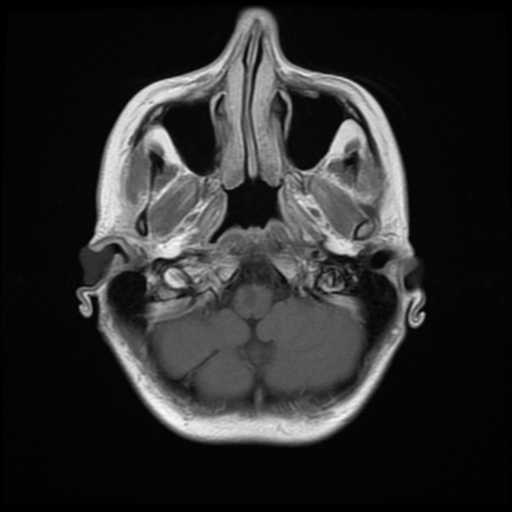 File:Neurofibromatosis type 2 - bilateral acoustic neuromata (Radiopaedia 40060-42566 Axial T1 C+ 3).png
