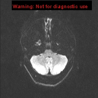 File:Neuroglial cyst (Radiopaedia 10713-11184 Axial DWI 41).jpg