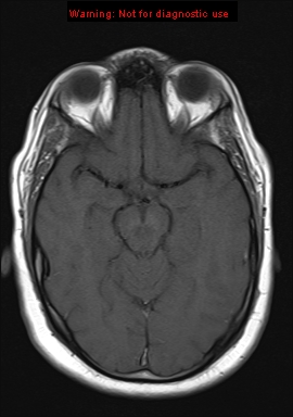 File:Neuroglial cyst (Radiopaedia 10713-11184 Axial T1 14).jpg