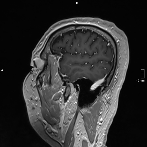 Neurosarcoidosis - involvement of the mesial temporal lobes (Radiopaedia 67429-76820 Sagittal T1 C+ 32).jpg