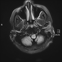 File:Neurotoxoplasmosis - concentric target sign (Radiopaedia 70644-80784 Axial FLAIR 3).jpg
