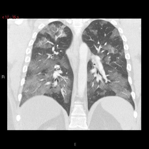 File:Non-specific interstitial pneumonitis (Radiopaedia 27044-27222 Coronal lung window 35).jpg
